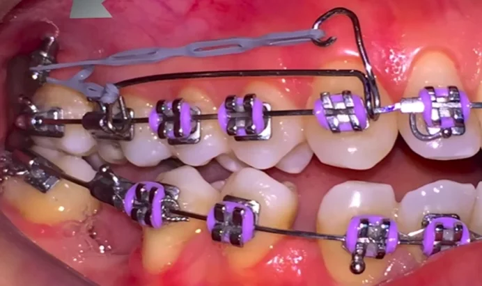 Distalização, extração, compensação ou cirurgia