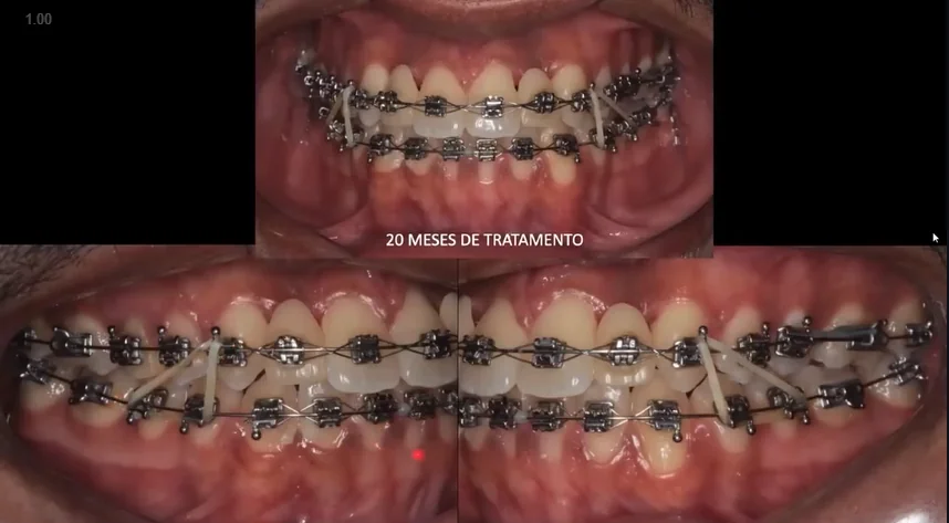 Escolha da mecânica